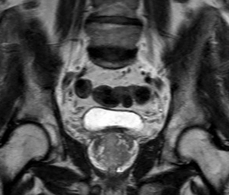 15/1/2018 Συμβολή MRI προστάτη: A. Εντοπισμός όγκου B.