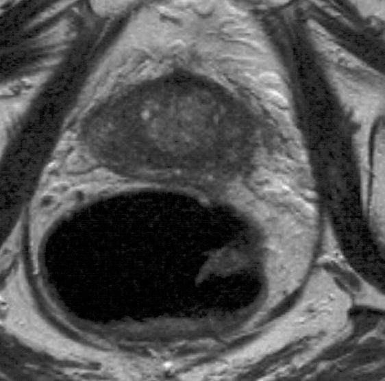 όχι βεβαιότητα διήθησης T3a Εξωπροστατική επέκταση Διήθηση αγγειονευρώδους δεματίου Ανώμαλο bulging ή διάσπαση της κάψας