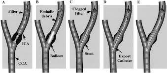 EMBOLUS PROTECTION DEVICE (EPD) A meta-analysis of 24 studies observed that