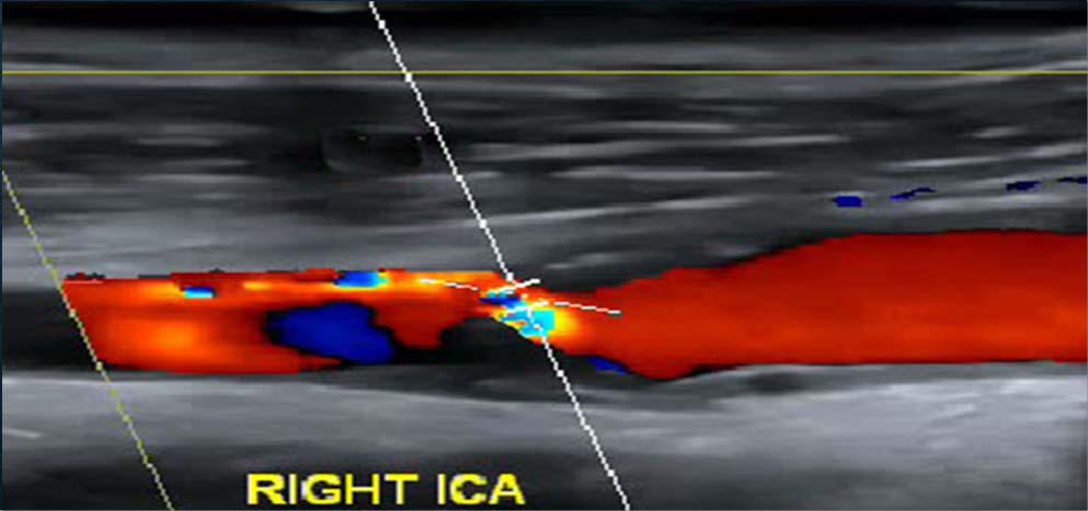 Επιφάνεια αθηρωματικής πλάκας - Εξελκωμένη πλάκα - Επιφανειακοί θρόμβοι - Νεοαγγείωση (CT, MRI,CONTRAST) - Πάχος της ινώδους κάψας Ανάλυση όγκου Κίνηση της αθηρωματικής πλάκας