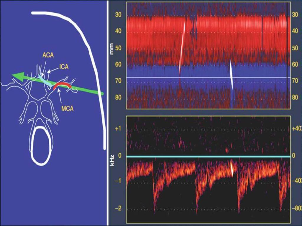 4. TCD MICRO-EMBOLIC SIGNALS (MES) ACES Study (467 pts with > 70% stenosis) Baseline TCD Embolic Signals and Ipsilateral Carotid Territory Events (2