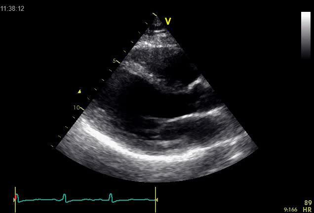 Αποκλεισμός άλλων αιτίων καρδιακής ανεπάρκειας Προγνωστικές πληροφορίες (συστολική λειτουργία LV,RV) και διαχρονική παρακολούθηση Echo (ανατομικές, λειτουργικές και αιμοδυναμικές