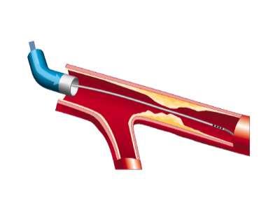 Calculation of mean transit time (Tmn) Proximal