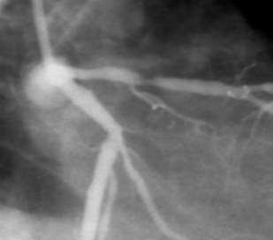 Myocardial Fractional Flow Reserve: Definition Fractional Flow Reserve is a ratio FFR = Q s max max Q N maximal myocardial flow in the