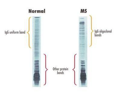 Έλεγχος πρωτεϊνών Η/Φ Ολιγοκλωνικές ζώνες σε MS Παραγωγή ανοσοσφαιρινών αύξηση γ σφαιρίνης (CSF IgG/plasma IgG)/(CSF albumin/plasma albumin) Σε
