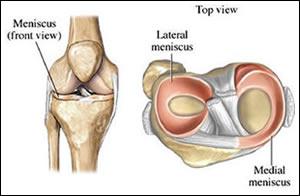 22 Οι δομές της άρθρωσης του γόνατου 2.4 Μηνίσκοι 2.4.1 Μηχανικές ιδιότητες και σύσταση Δύο πολύ βασικές δομές του γόνατου είναι οι μηνίσκοι: ο έσω και ο έξω.