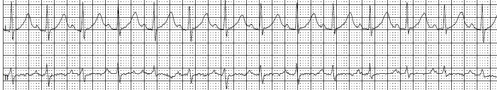 μαραθωνοδρόμος σε ηρεμία (ΚΣ = 43/min) PR = 256 ms