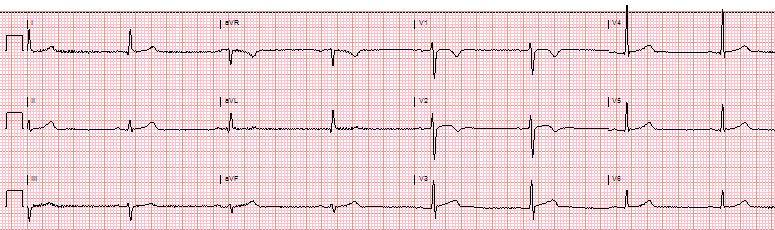 δυναμικό QRS για LVH ή