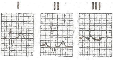 θώρακα, τότε ο ηλεκτροκαρδιογράφος καταγράφει θετικό κύμα. Στην εικόνα η απαγωγή Ι = V LA - V RA (οι τιμές λαμβάνονται με τα πρόσημά τους).