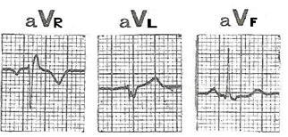 Εικόνα 29: Φυσιολογικά ηλεκτροκαρδιογραφήματα που λαμβάνονται απαγωγές των άκρων av R, av L, av F.