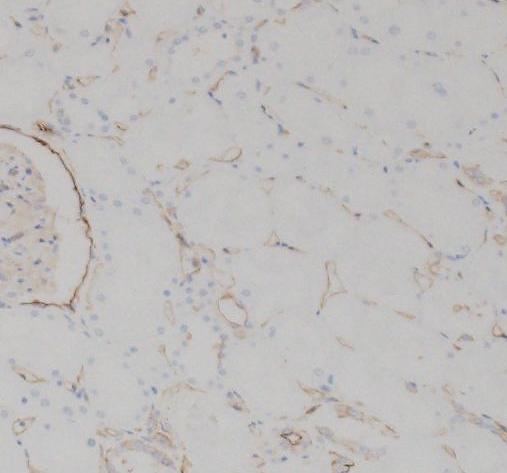 clear cell RCCs, the distal tubules and glomeruli in N samples.