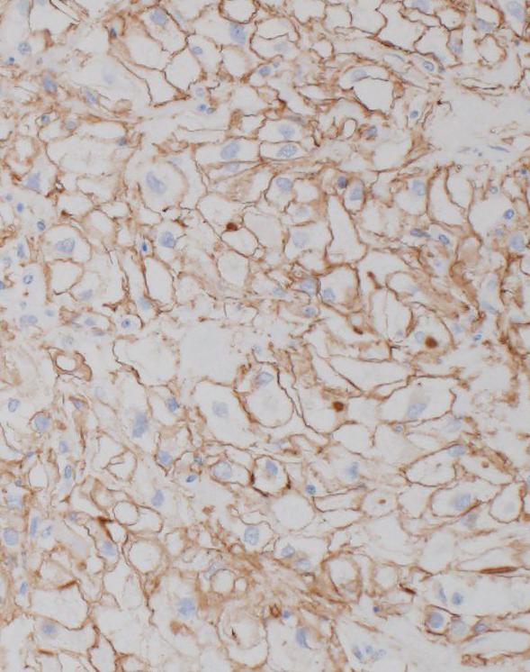 samples. (C) Almost all epithelial cells showed strong nuclear immunoreac)vity for MSH2 in N samples.