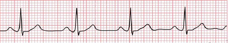 ELECTROCARDIOGRAFE Electrocardiograf cu 3 canale SE 300 B Edan Instruments/China http:///aparaturamedicala/produse/detalii-produselectrocardiograf-cu-3-canale-se300b-1071.