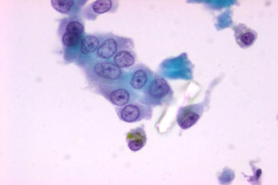 7. Όγκοσ από κύτταρα Hurthle Μονοεπύπεδοι ςχηματιςμού, ομϊδεσ και μεμονωμϋνα