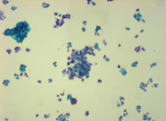 7. Όγκοσ από κύτταρα Hurthle Μονοεπύπεδοι ςχηματιςμού, ομϊδεσ και μεμονωμϋνα