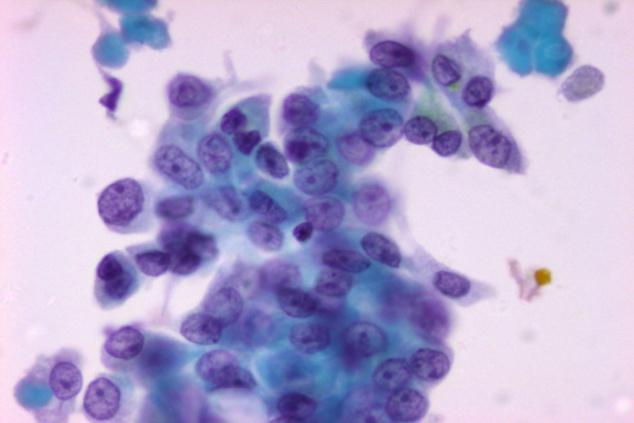 7. Όγκοσ από κύτταρα Hurthle Μονοεπύπεδοι ςχηματιςμού, ομϊδεσ