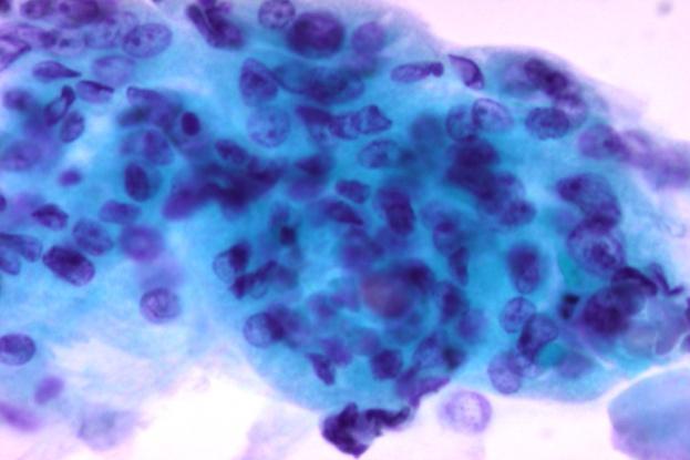 7. Όγκοσ από κύτταρα Hurthle Σεντόνια, ομϊδεσ και μεμονωμϋνα οξύφιλα κύτταρα. Ομοιόμορφοσ κυτταρικόσ πληθυςμόσ.