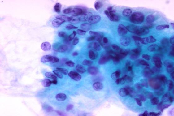 7. Όγκοσ από κύτταρα Hurthle Σεντόνια, ομϊδεσ και μεμονωμϋνα οξύφιλα κύτταρα. Ομοιόμορφοσ κυτταρικόσ πληθυςμόσ.