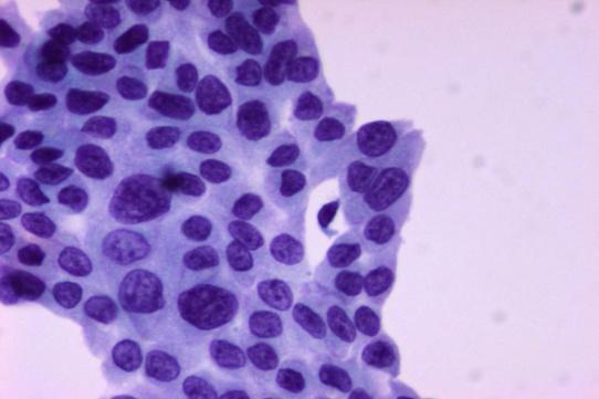 Αυξημϋνη κυτταροβρύθεια των κυτταρικών αθρούςεων Θηλώδεισ ομϊδεσ με ενδοθηλιακϊ κύτταρα και αληθεύσ ινοςυνδετικούσ ϊξονεσ.