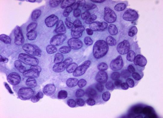 Αυξημϋνη κυτταροβρύθεια των κυτταρικών αθρούςεων Θηλώδεισ ομϊδεσ με ενδοθηλιακϊ κύτταρα και αληθεύσ ινοςυνδετικούσ ϊξονεσ.