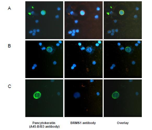 BRMS1 expression in cytospin stained CTC of early breast cancer patients.