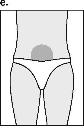 Βήμα 2 - Το σημείο ένεσης Το καλύτερο σημείο για μία ένεση κάτω από το δέρμα είναι το κάτω μέρος του στομάχου γύρω από τον ομφαλό όπου υπάρχει αρκετό χαλαρό δέρμα και στρώματα λιπώδους ιστού (e).