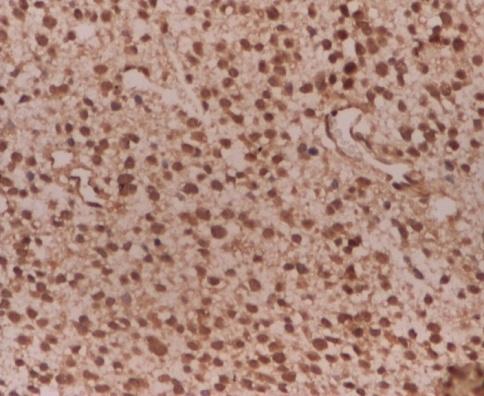 Analiza imunohistochimică a demonstrat prezenţa expresiei VEGF şi bfgf în majoritatea cazurilor studiate, cu preponderenţă în tumorile cerebrale invazive, ceea ce concordă cu potenţialul de