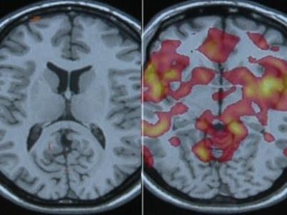 PFC, anterior