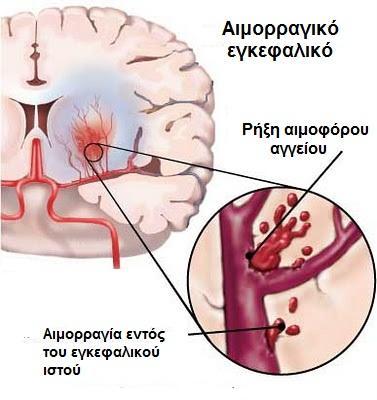 εγκεφάλου και σχηματισμό ενός εγκεφαλικού αιματώματος