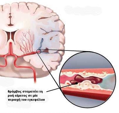 Ταξινόμηση ΑΕΕ Ισχαιμικό αγγειακό εγκεφαλικό επεισόδιο : Σε αυτή τη περίπτωση το αίμα μπορεί να