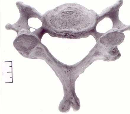 הערכת האוסטיאופיטיים בגוף החוליה body) :(Vertebral דרגה 1: מצב תקין - גוף חוליה ללא אוסטיאופיטים (תמונה