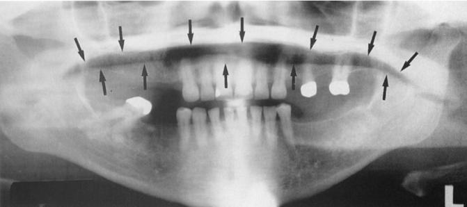 Εάν η γλώσσα δεν τοποθετηθεί στην οροφή του στόματος προκύπτει διαγαστική λωρίδα στην περιοχή των ριζών των δοντιών της άνω γνάθου (From Haring J, Jansen L: