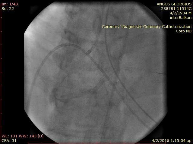 Μετά την τοποθέτηση του stent, διάνοιξη του