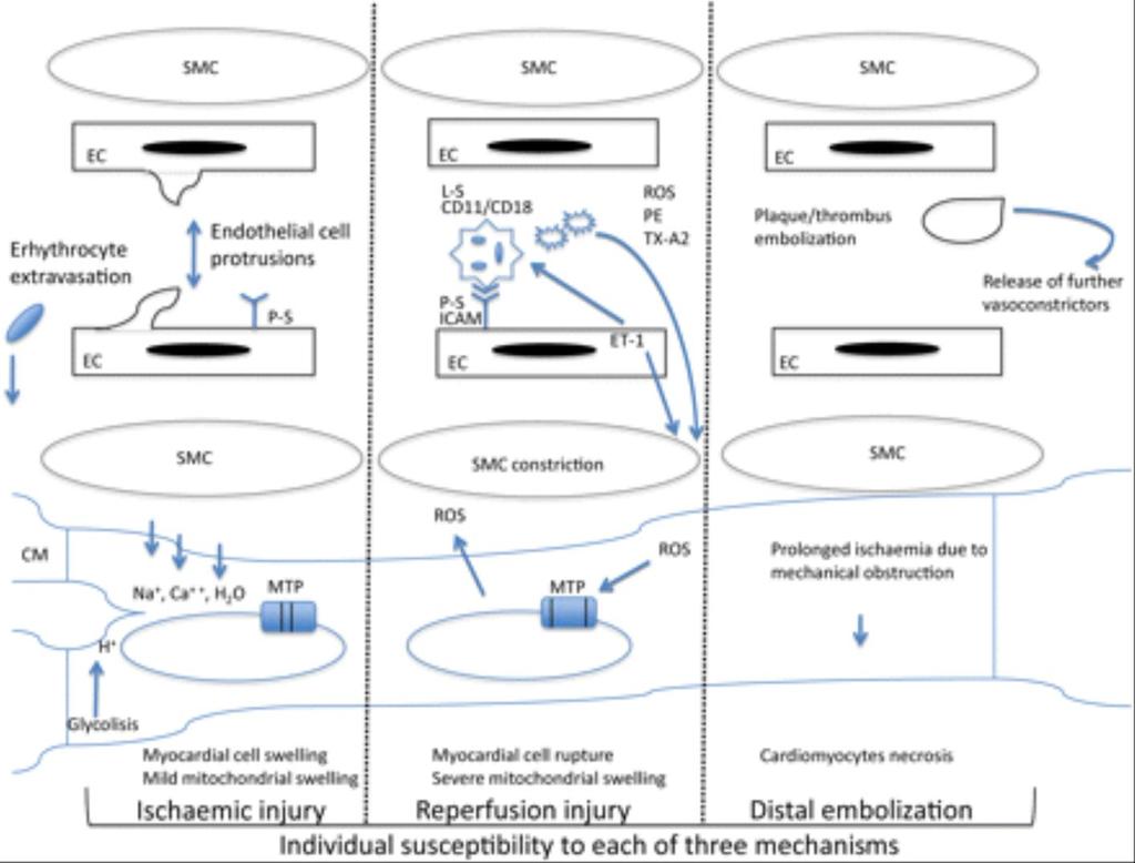 From: No-reflow: again prevention is better than treatment Eur Heart J. 2010;31(20):2449-2455. doi:10.