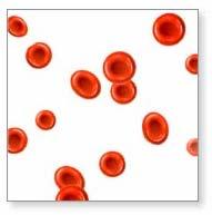 ANEMIJA je smanjenje broja crvenih krvnih stanica, uslijed nedostatka željeza SIMPTOMI: blijeda boja kože, umor,