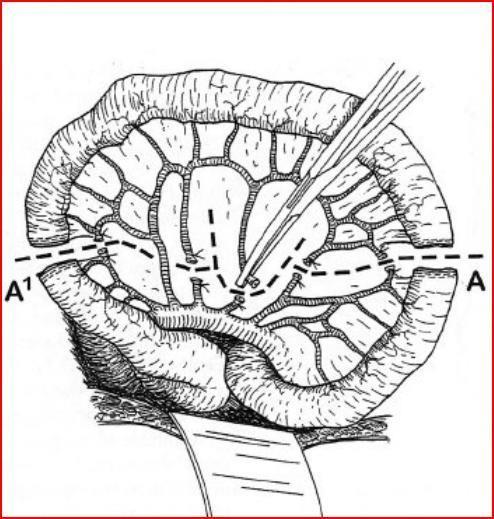 και κινητοποίηση του προς αφαίρεση τμήματος του στομάχου, ο οισοφάγος παρασκευάζεται δακτυλικά κατά το κατώτερο 3μόριό του δια μέσου του οισοφαγικού τρήματος και κατά το άνω και μέσο 3μόριό του διά