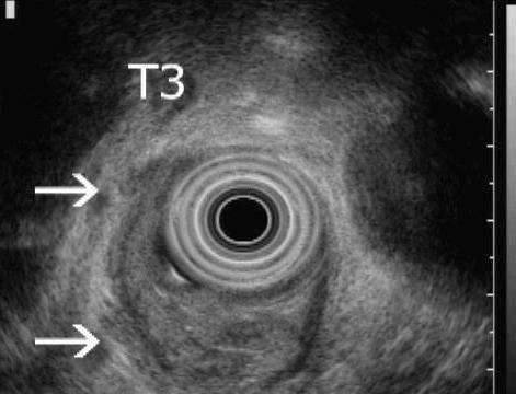 Εικόνα 9: Ενδοαυλική υπερηχογραφία σε ασθενή με καρκίνωμα του οισοφάγου.