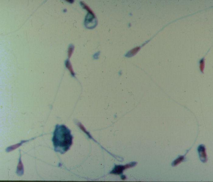 Sperm morphology patterns: Μοτίβα Μορφολογίας Elongated spermatozoa pattern DNA