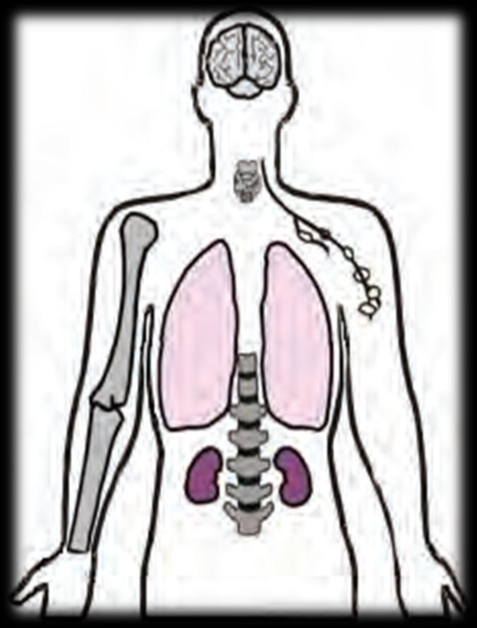 Εστίες δευτεροπαθούς Φυματίωσης Reactivation Disease (ή Reinfection) Πνευμονική TB (85%) άνω λοβοί ή κορυφαίοι των κάτω