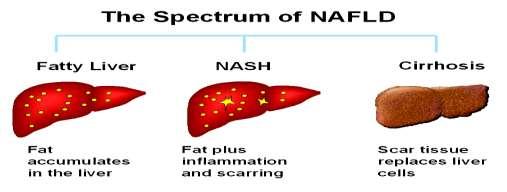Το φάσμα της μη αλκοολικής νόσου του ήπατος (NAFLD/ΜΑΛΝΗ) Στεάτωση Στεατοηπατίτιδα (NASH)