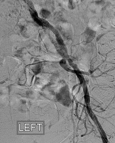בהשוואה בין טבלאות 6 ו iliac ( 7 )Right external לטבלאות 4 ו iliac( 5 )Right common רואים ששיטת ה CIP מדויקת יותר בכלי הדם החיצוני iliac( external