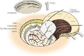 Χειρουργική προσπέλαση κρανιακής κοιλότητας Οι χειρουργοι προσεγγιζουν κρανιακη κοιλότητα και εγκεφαλο με κρανιοτομή (τμημα του κρανίου ανασηκώνεται ή αφαιρείται) Η