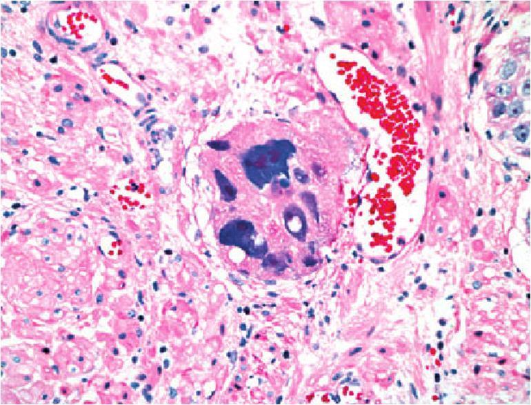 Πλειόμορφο γιγαντοκυτταρικό αδενοκαρκίνωμα (Pleomorphic giant cell adenocarcinoma) Εξαιρετικά σπάνιος τύπος αδενοκαρκινώματος, με γιγάντιους πλειόμορφους πυρήνες.