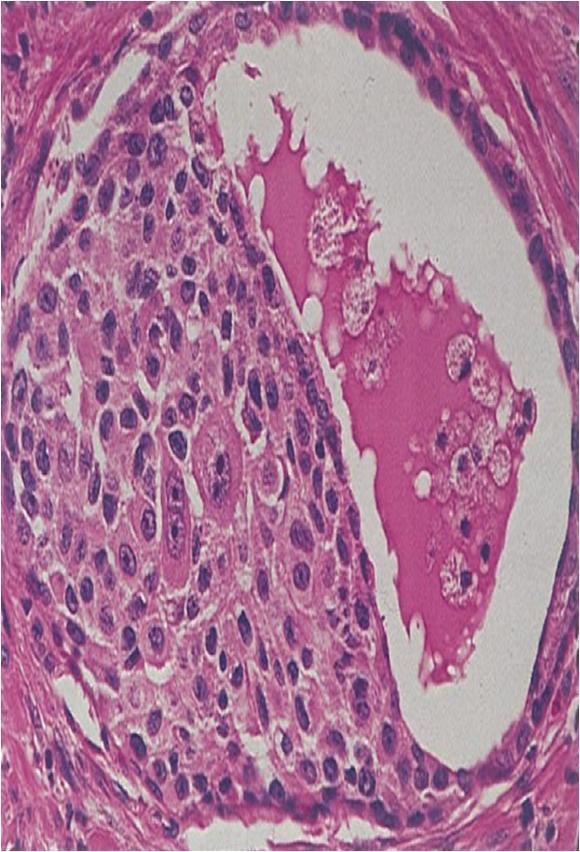 Ουροθηλιακό καρκίνωμα (Urothelial carcinoma) Συνήθως σχετίζεται με ένα πρωτοπαθές καρκίνωμα της ουροδόχου κύστεως ή της ουρήθρας (15-48%).