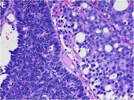 Υψηλού βαθμού κακοήθειας νευροενδοκρινές καρκίνωμα (μικροκυτταρικό) (High-grade neuroendocrine carcinoma) [small cell