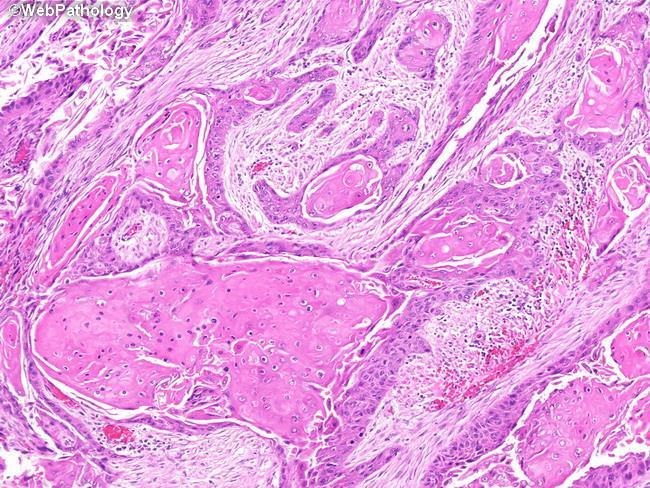 Squamous cell neoplasms Pure squamous cell carcinoma Προέλευση από το