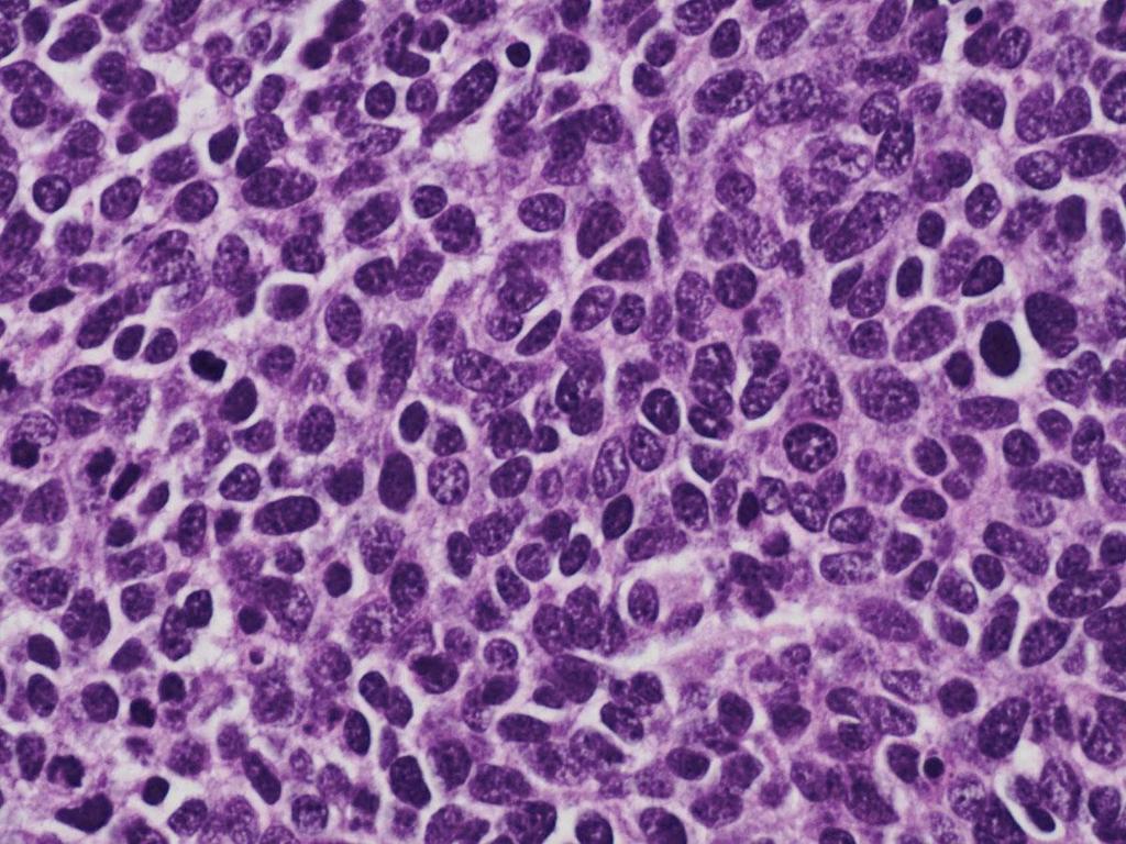Small cell carcinoma <1% των κακοήθων όγκων Μεταστάσεις σε
