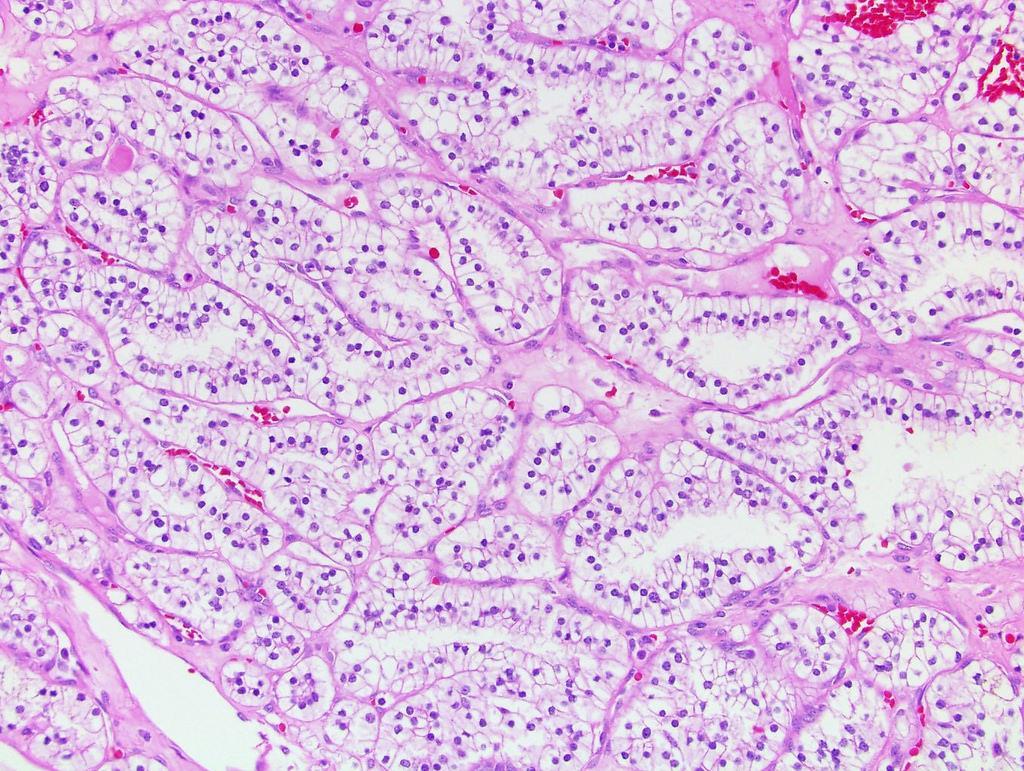 Clear cell papillary renal cell carcinoma Εξαιρετική πρόγνωση ICDO: