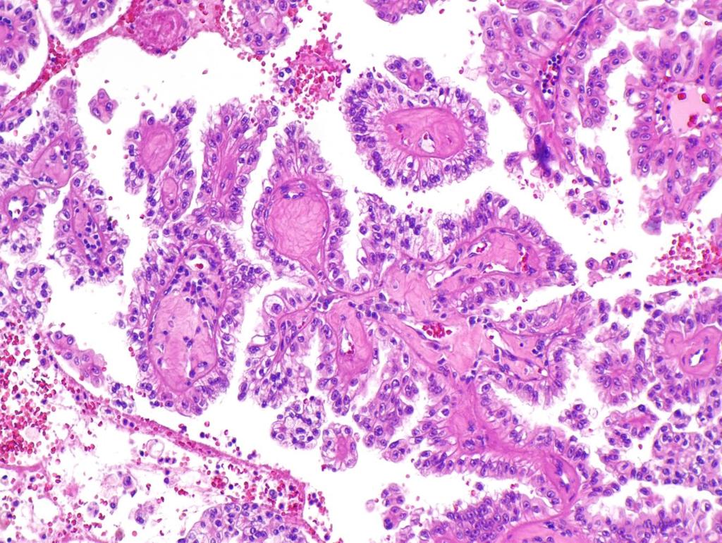 Hereditary leiomyomatosis associated renal cell carcinoma Πολύ σπάνια οντότητα Θηλώδης μορφολογία Σπανιότερα μορφολογία