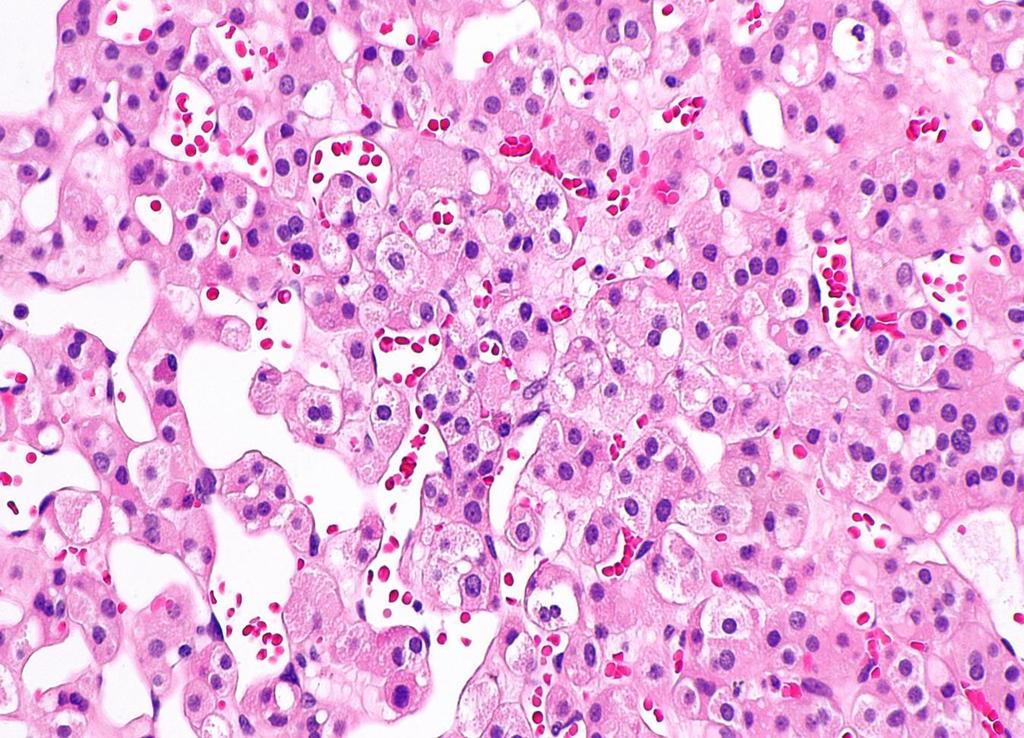 Succinate dehydrogenase-deficient renal cell carcinoma Απώλεια έκφρασης του SDHB